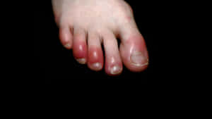 A Close-up View Of Covid Toes Syndrome Wallpaper