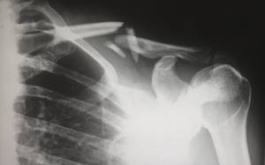 Shoulder Bone X-ray Wallpaper